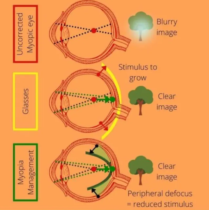 Myopia Management